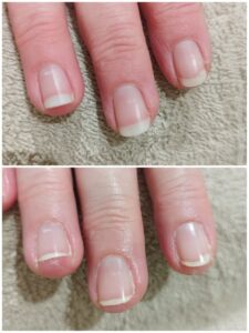 ongles fragiles