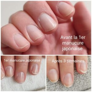 Ongles mous striés et dédoublés cassant