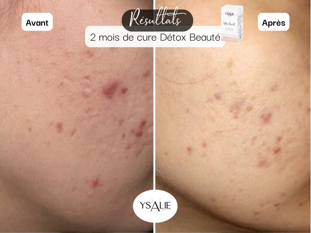 joue avec boutons et cicatrice acné