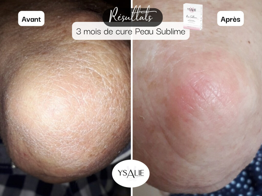 Peau séche et squameuse