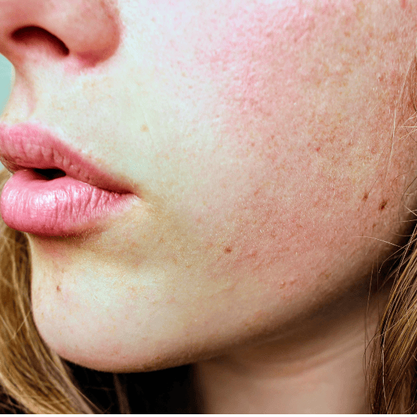 Peau sensible : comment en prendre soin sans l’agresser ?